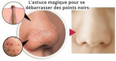 L'astuce magique pour se débarrasser des points noirs
