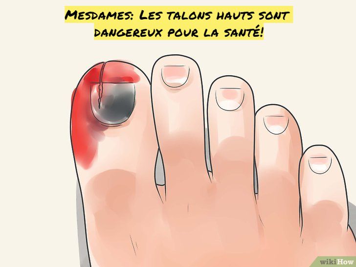 Blessures aux orteils Mesdames: Les talons hauts sont dangereux pour la santé!