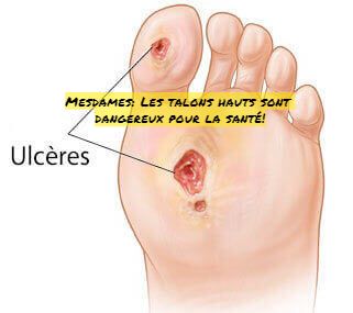 Ulcères du pied Mesdames: Les talons hauts sont dangereux pour la santé!