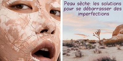 Peau sèche: les solutions pour se débarrasser des imperfections
