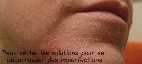 Peau sèche: les solutions pour se débarrasser des imperfections