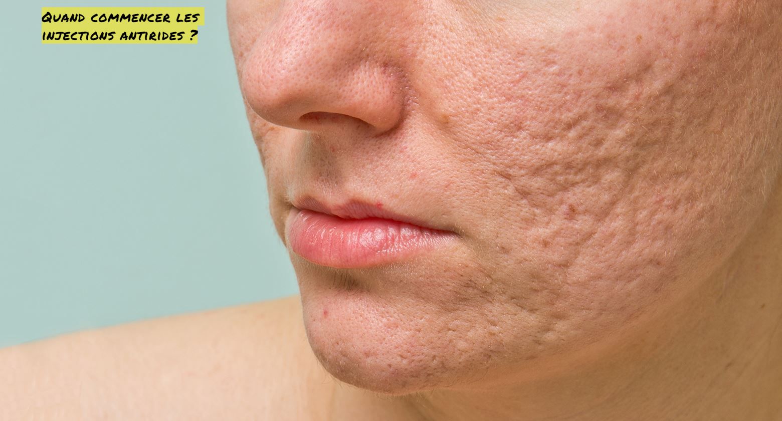 Commencez les injections antirides Quand commencer les injections antirides ?