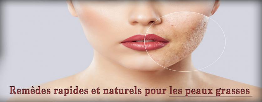 Remèdes rapides et naturels pour les peaux grasses 