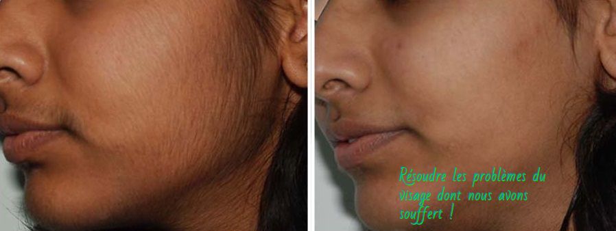 Les poils sur le visage Résoudre les problèmes du visage dont nous avons souffert