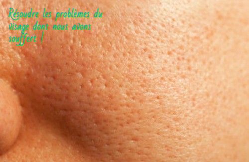 Les pores larges Résoudre les problèmes du visage dont nous avons souffert