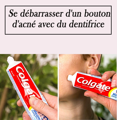Se débarrasser d'un bouton d'acné avec du dentifrice