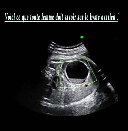 Voici ce que toute femme doit savoir sur le kyste ovarien !